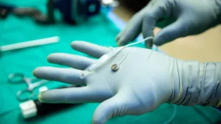 Прорыв в нейротехнологиях: первый человек получил имплант для восстановления речи